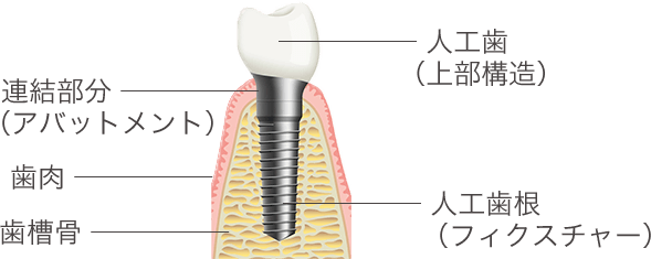 インプラントの仕組み