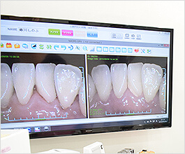 口腔内カメラで治療を見える化