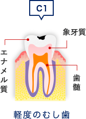 軽度のむし歯