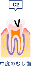 中度のむし歯