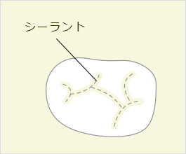 シーラント