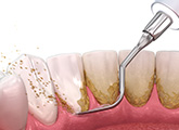歯石の除去