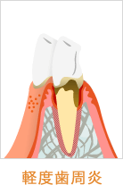 軽度歯肉炎