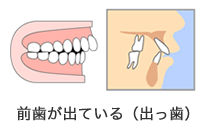 前歯が出ている（出っ歯）