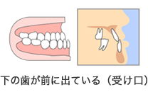 下の歯が前に出ている（受け口）