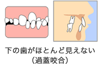 下の歯がほとんど見えない（過蓋咬合）