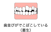 歯並びがでこぼこしている（叢生）