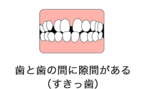 歯と歯の間に隙間がある（すきっ歯）