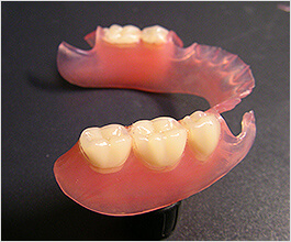 バネのない入れ歯「ノンクラスプデンチャー」