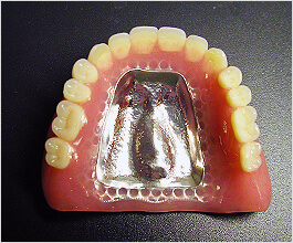 違和感の少ない機能美デンチャー「金属床義歯」